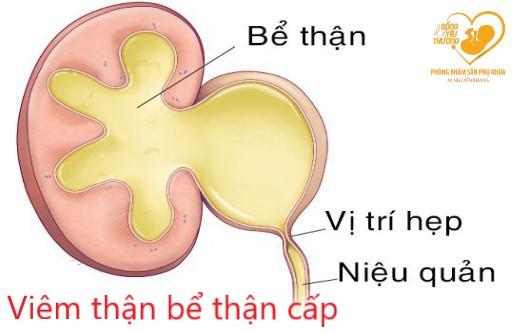 viêm thận - bể thận cấp bệnh lý không thể coi thường