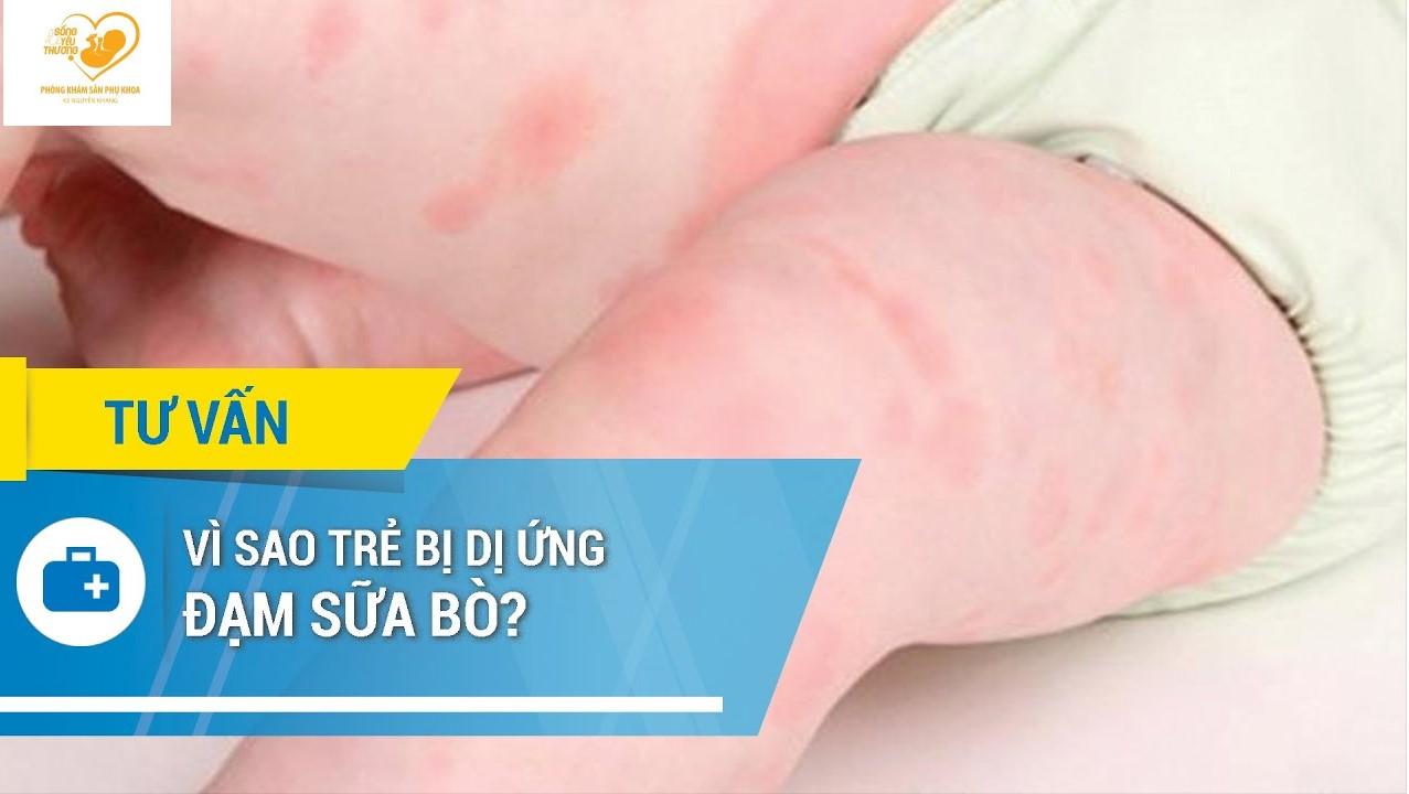 Dị ứng đạm sữa bò là gì? Tại sao bé bị dị ứng đạm sữa?