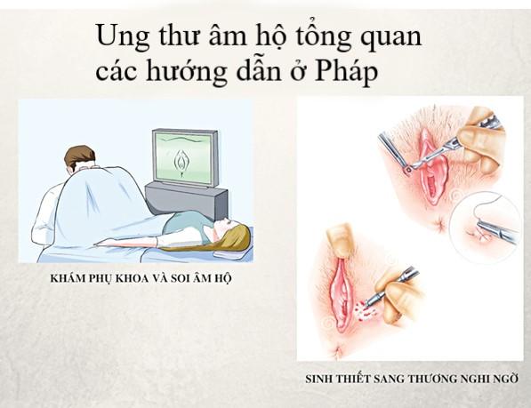 Ung thư âm hộ tổng quan các hướng dẫn ở Pháp