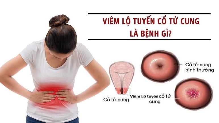 Nguyên nhân gây viêm lộ tuyến cổ tử cung