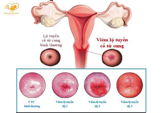 5 Nguyên nhân hàng đầu gây viêm lộ tuyến cổ tử cung