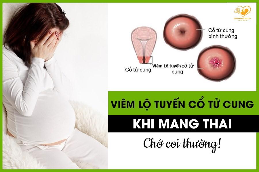Điều trị và dự phòng viêm lộ tuyến cổ tử cung khi mang thai