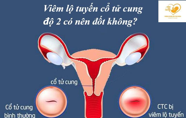 Viêm lộ tuyến cổ tử cung độ 2 có nên đốt không?