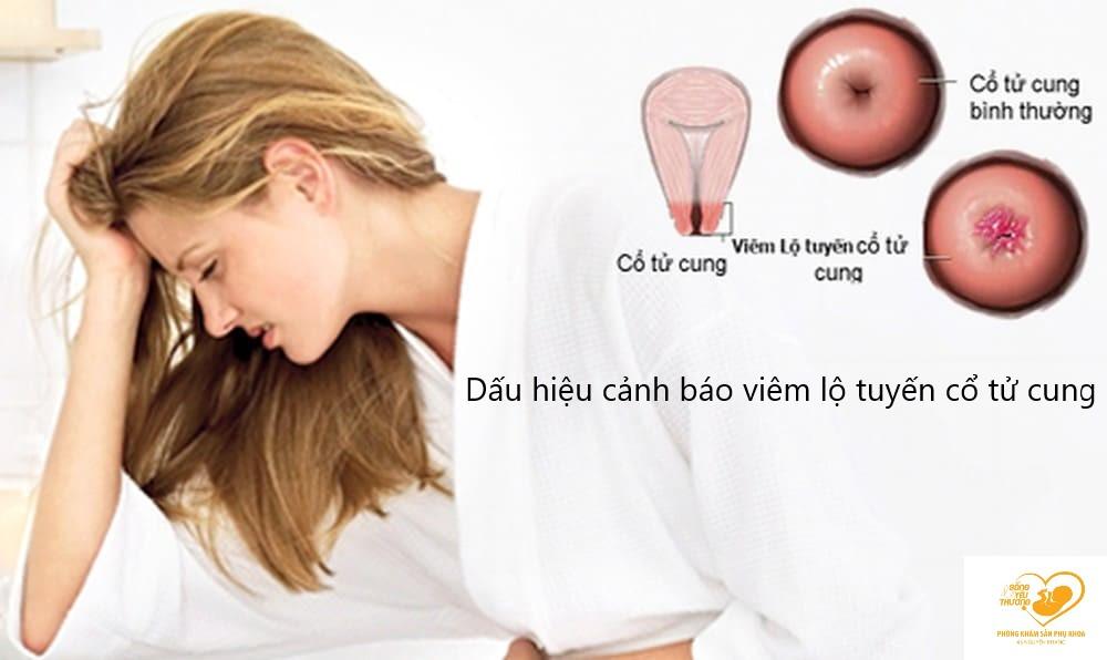 Dấu hiệu cảnh báo bạn đang bị viêm lộ tuyến cổ tử cung