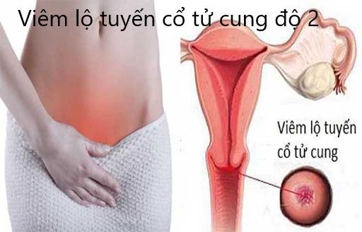 Viêm lộ tuyến cổ tử cung cấp độ 2 là gì?