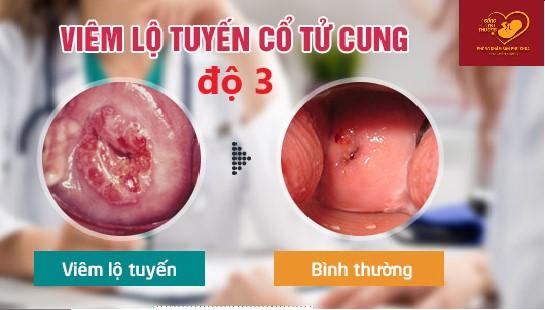 Viêm lộ tuyến cổ tử cung độ 3 là gì?