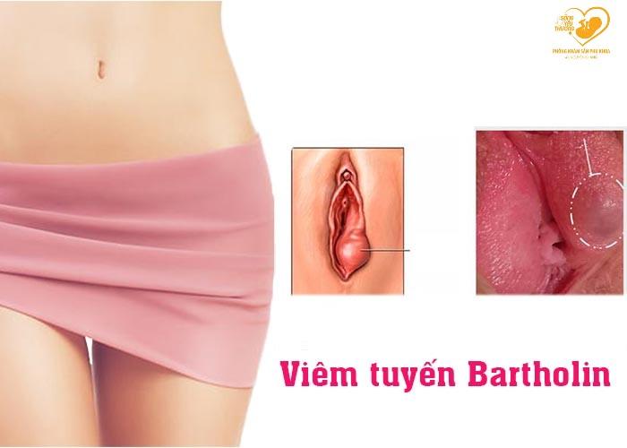 Tìm hiểu viêm tuyến Bartholin