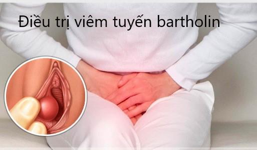 Cách điều trị viêm tuyến bartholin hiệu quả nhất