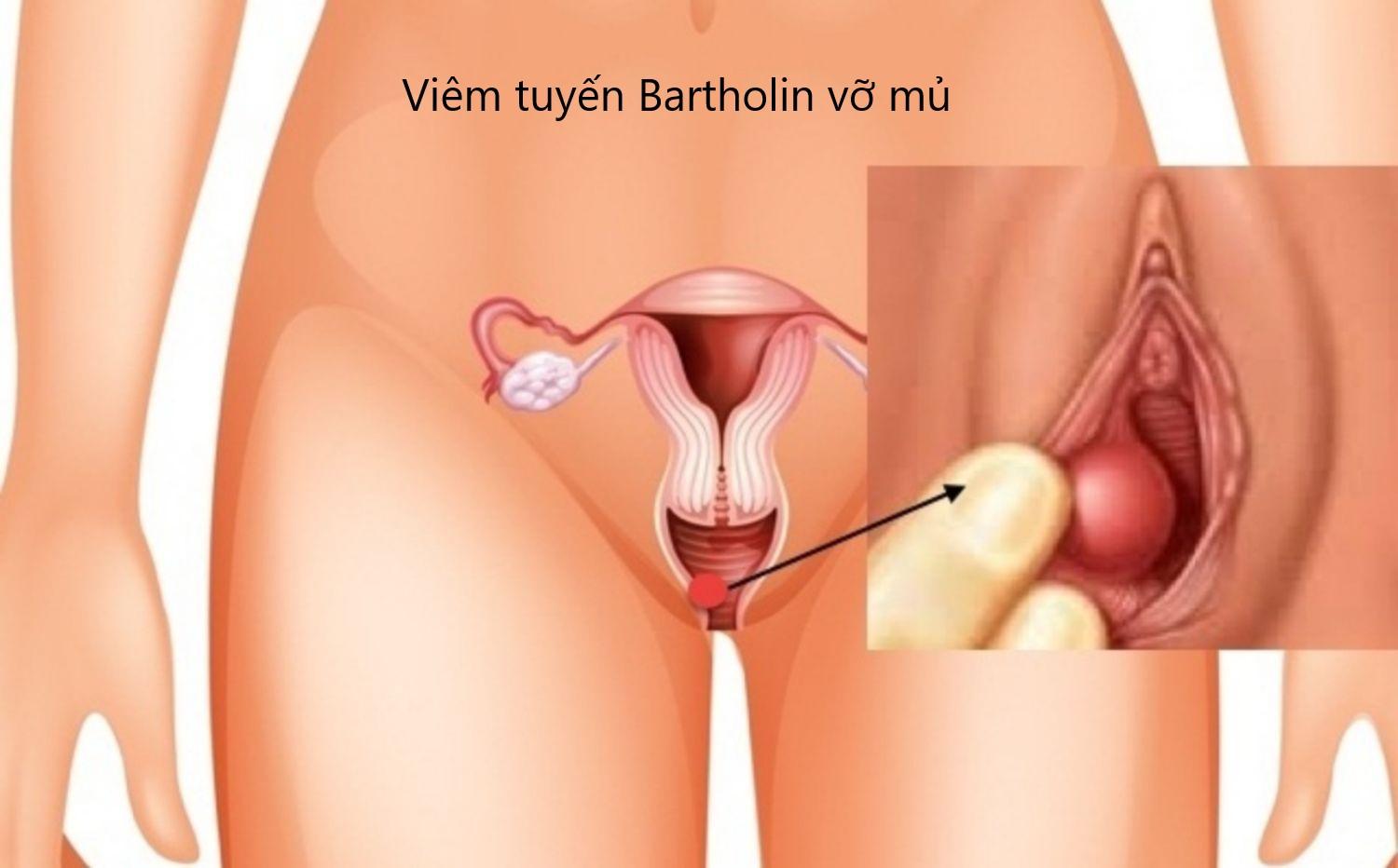 Viêm tuyến bartholin vỡ mủ có nguy hiểm không?