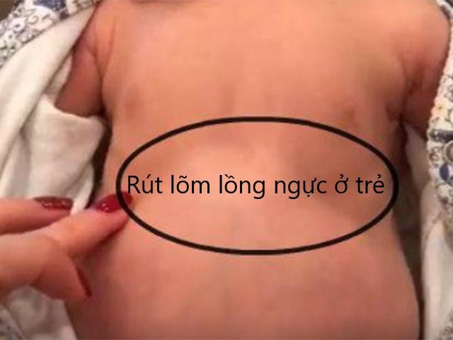 Tìm hiểu rút lõm lồng ngực ở trẻ em