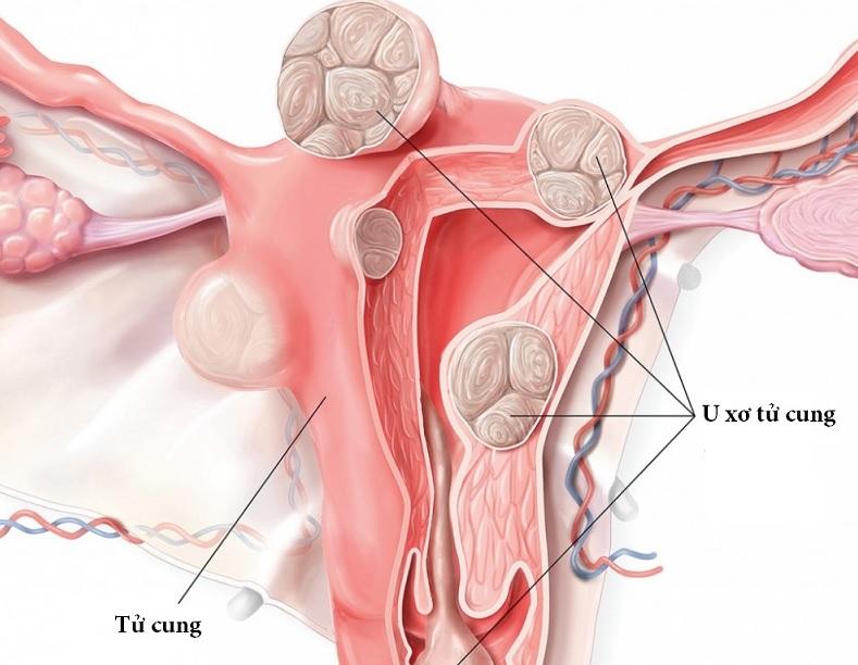 Khi nào cần điều trị u xơ tử cung?