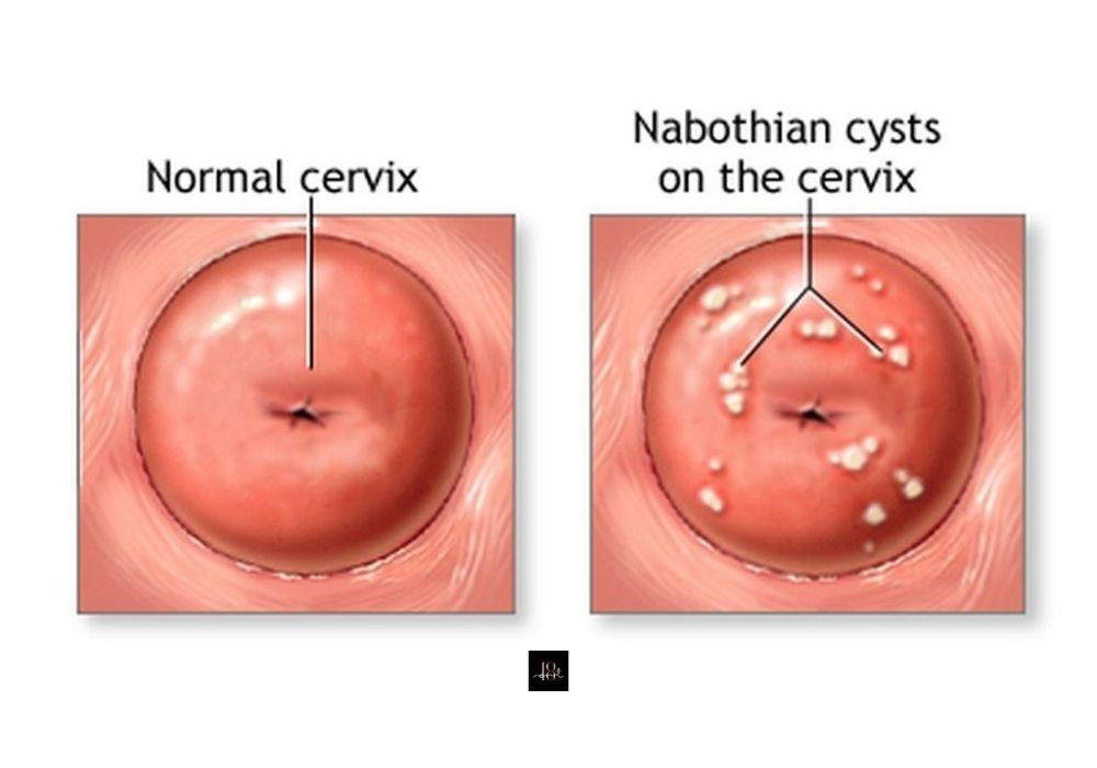 Nguyên nhân, dấu hiệu nhận biết nang Naboth cổ tử cung