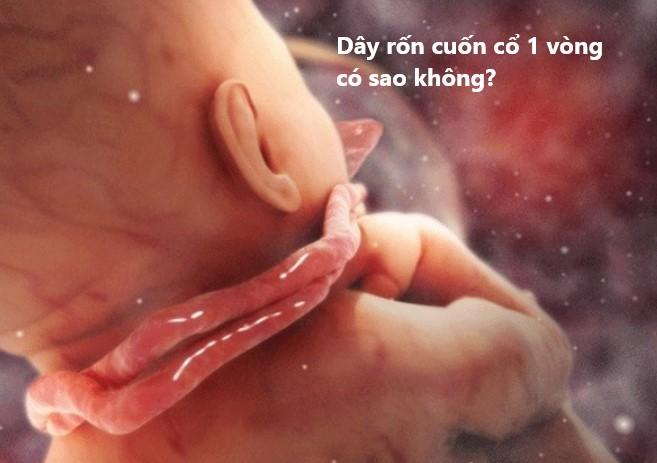 Thai bị dây rốn quấn cổ có sao không?