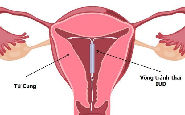 Tại sao sinh mổ không nên đặt vòng tránh thai?