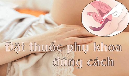 Hướng dẫn cách đặt thuốc phụ khoa đúng cách