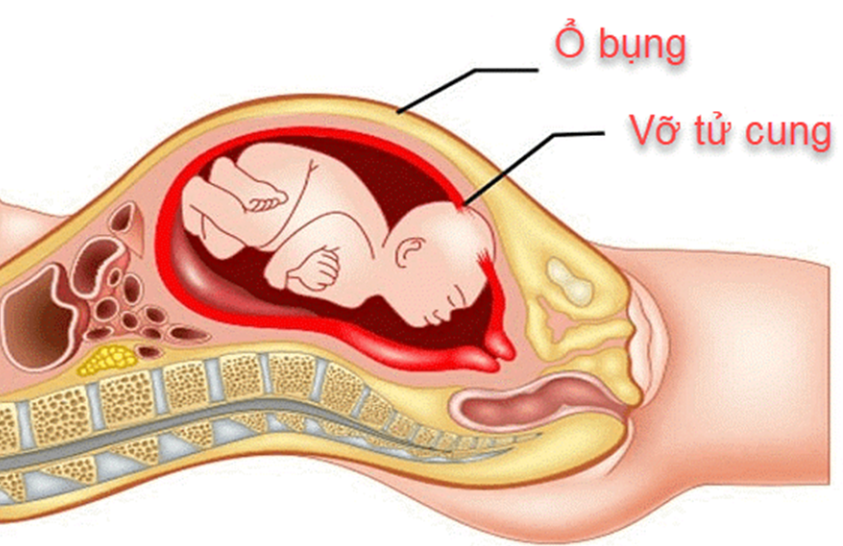 Chẩn đoán và điều trị vỡ tử cung