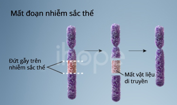 4 hội chứng mất đoạn nhiễm sắc thể thường gặp