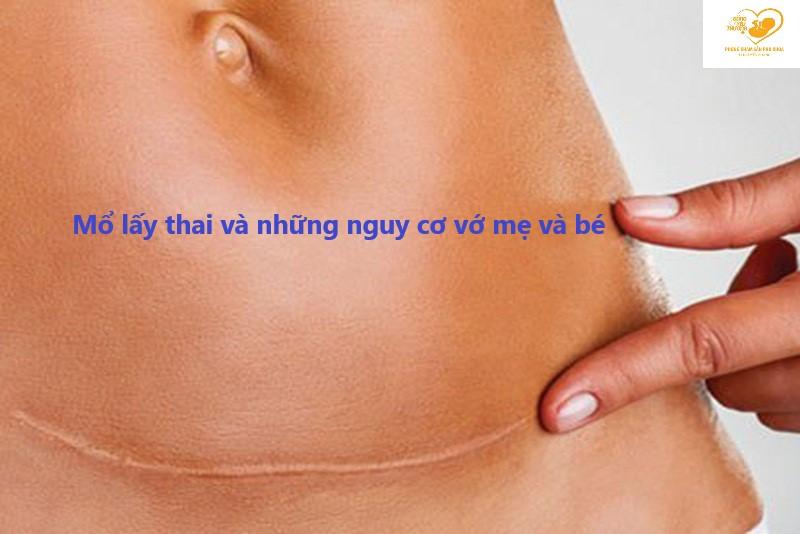 Mổ lấy thai và những nguy cơ biến chứng với mẹ và bé