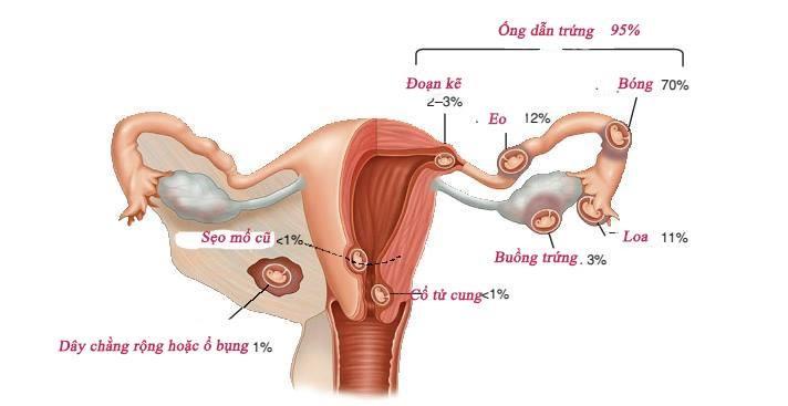 Thai ngoài tử cung: nguy cơ từ viêm nhiễm phụ khoa