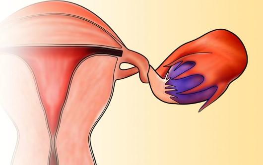 Xoắn buồng trứng - mối đe doạ đến khả năng sinh sản