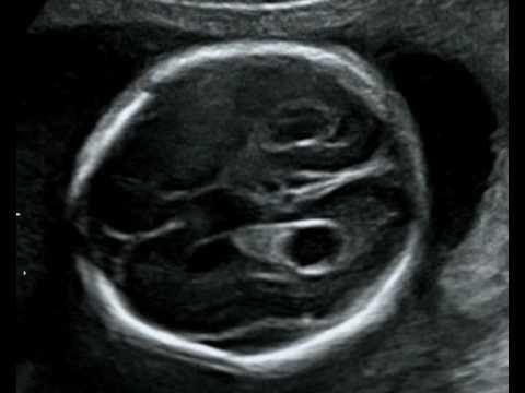 Nang đám rối mạch mạc ở não có nguy hiểm không?