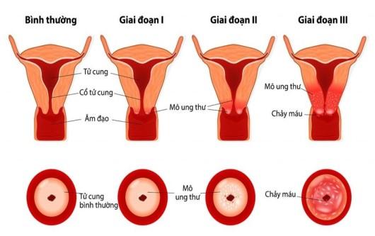Ung thư cổ tử cung có thể phòng tránh được không?