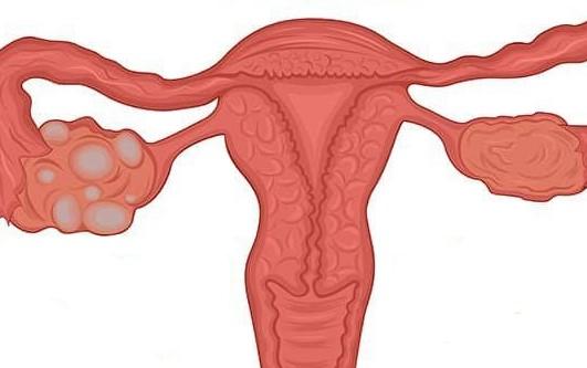 Hội chứng buồng trứng đa nang (PCOS)