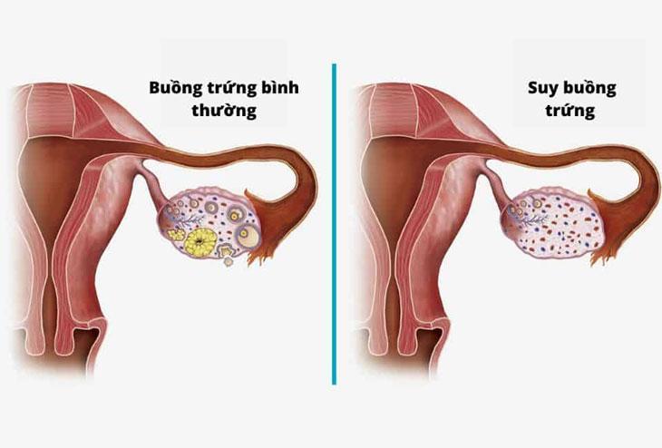 Nguyên nhân gây suy buồng trứng sớm