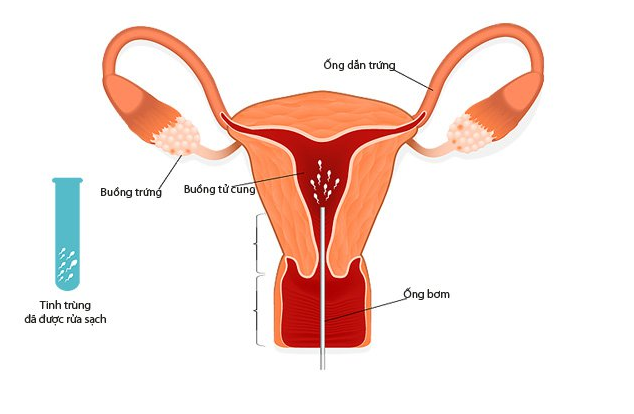 Bơm tinh trùng vào buồng tử cung (IUI) được thực hiện như thế nào?