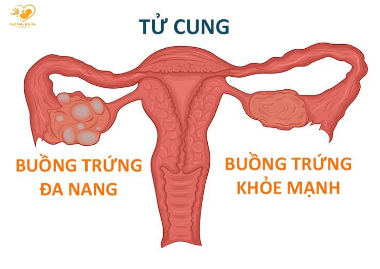 đa nang buồng trứng