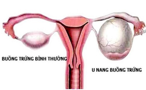 6 biện pháp phòng ngừa u nang buồng trứng