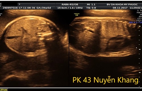 biến chứng teo thực quản bẩm sinh và tiên lượng sau phẫu thuật