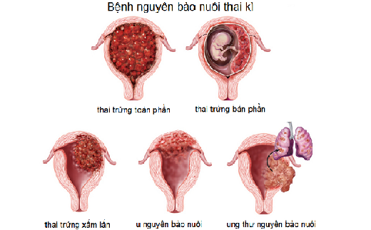 Chửa trứng là gì? Tại sao lại có hiện tượng chửa trứng
