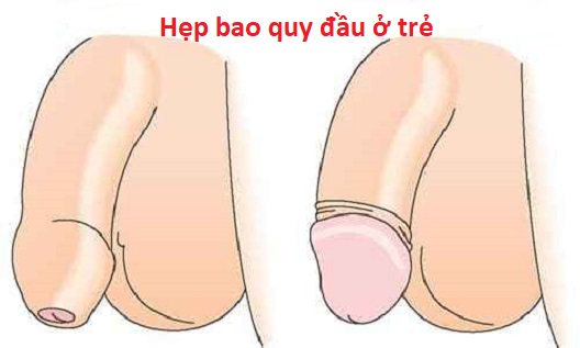 Hẹp bao quy đầu ở trẻ