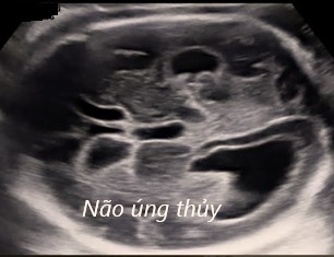 bất thường hệ thận niệu và hệ thần kinh trung ương