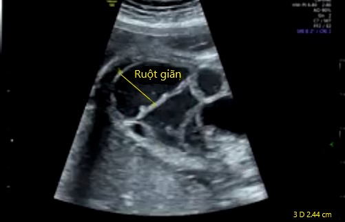 tắc ruột phân su - viêm phúc mạc phân su - hội chứng nút phân su