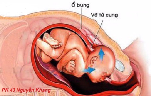 05 tai biến sản khoa nguy hiểm thường gặp