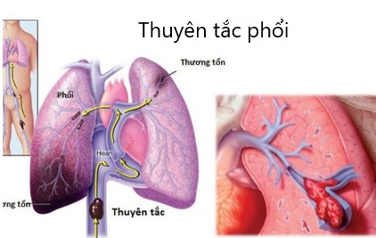 triệu chứng của bệnh huyết khối tĩnh mạch sâu