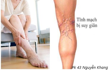 triệu chứng lâm sàng bệnh huyết khối tĩnh mạch sâu