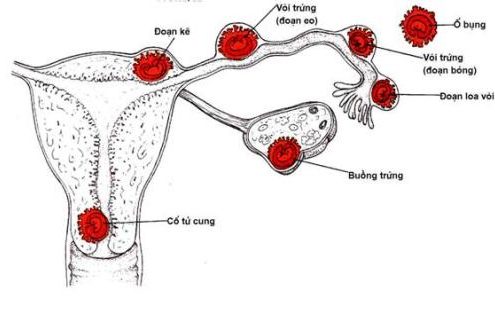 Có thai ngoài tử cung cần biết điều gì?
