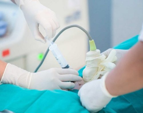  Những điều cần biết về chọc ối