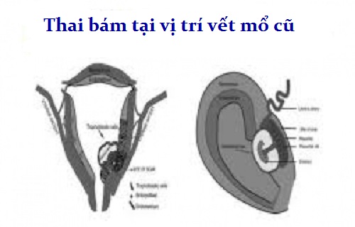 Chửa tại vết mổ – Mối nguy hiểm khôn lường