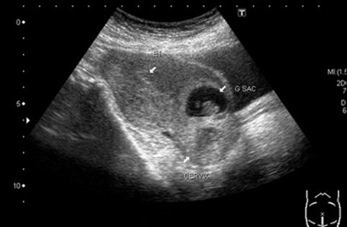 chửa tại vết mổ - mối nguy hiểm khôn lường