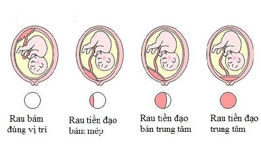 bất thường rau thai - rau tiền đạo