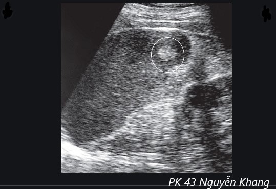 một số phương pháp điều trị u máu hiệu quả hiện nay