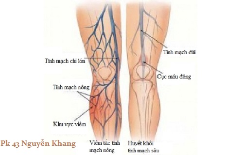 Viêm tắc tĩnh mạch - hình thái nhiễm khuẩn hậu sản