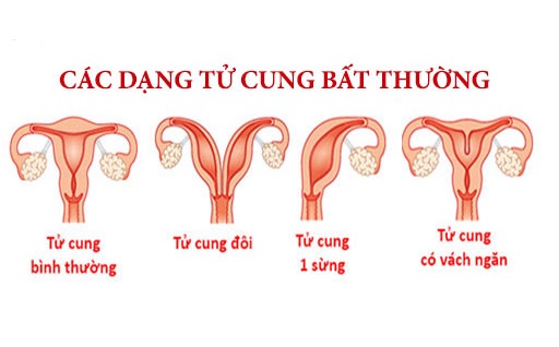 Tìm hiểu những bất thường ở tử cung ảnh hưởng tới mang thai