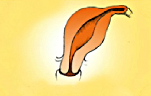 bất thường ở tử cung