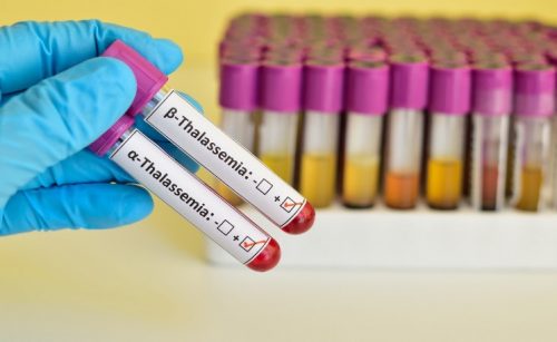 Nguyên nhân gây ra bệnh tan máu bẩm sinh beta thalassemia