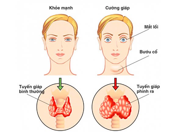 Điều trị cường giáp khi mang thai